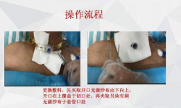 采血针的使用方法视频,轻松掌握采血技巧